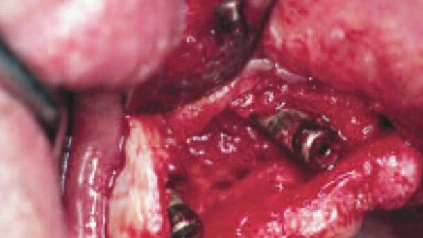 Cechy systemu implantów stomatologicznych i ich potencjalny wpływ na uzyskanie i utrzymanie efektu estetycznego