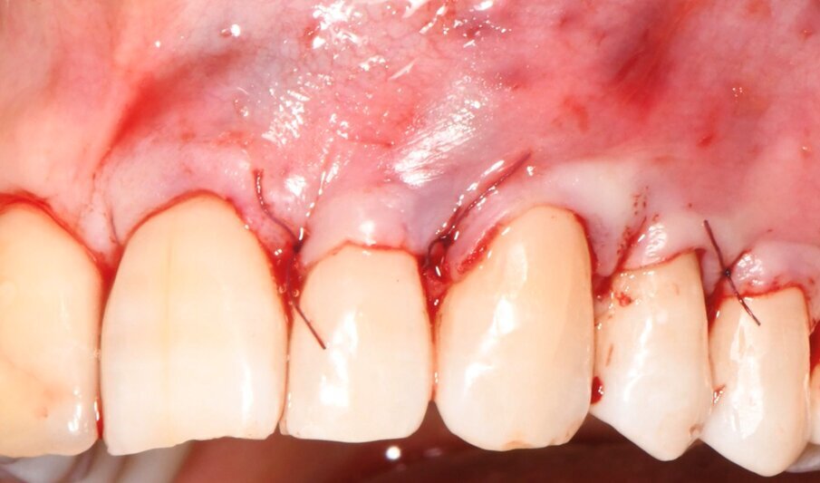 Fig. 6 - Il lembo a busta è posizionato coronalmente e fissato in sede con punti sospesi.
