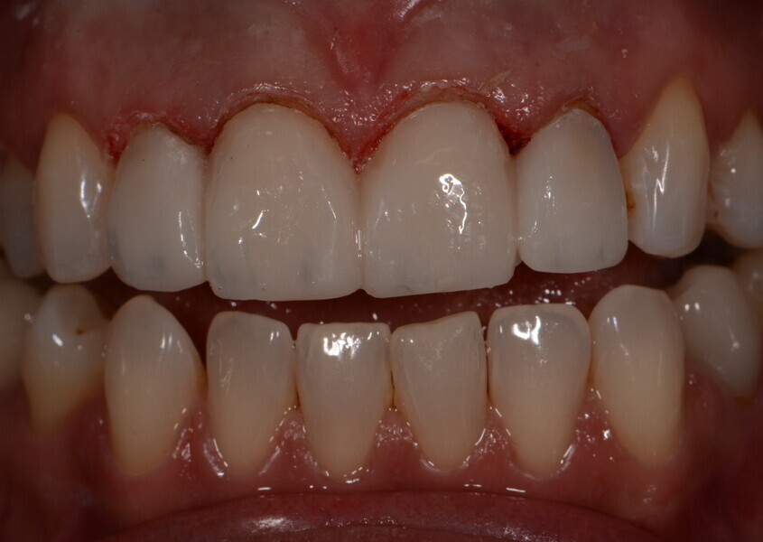 Fig. Fig. 8: Glazed printed provisional restorations made of V-Print c&b temp (VOCO) in place on the day of preparation.