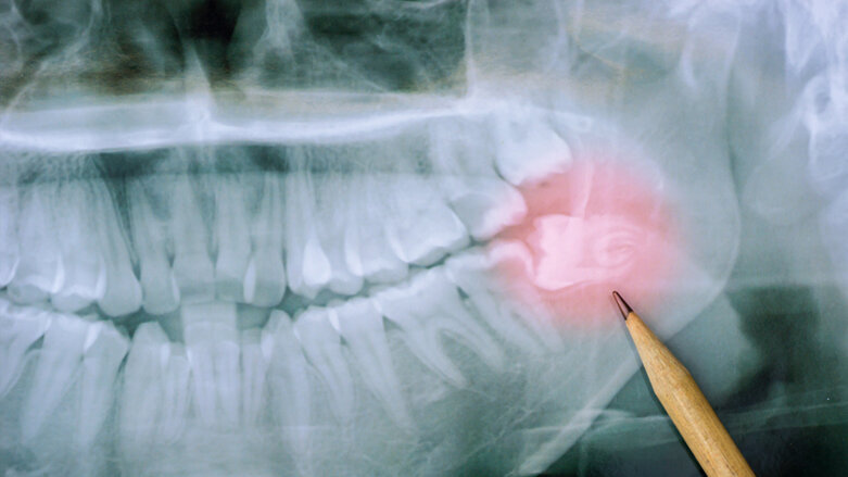 Aktualisierte S2k-Leitlinie zur Weisheitszahnentfernung