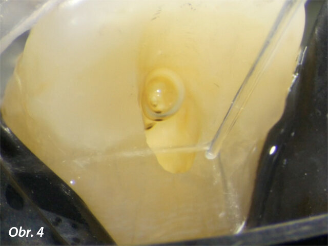 Příznačný design s kontralaterálními postranními vývody napomáhá k bezpečnosti a efektivitě