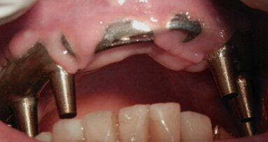 Regeneración Tisular Guiada con Barreras Oclusivas confeccionadas por CAD-CAM