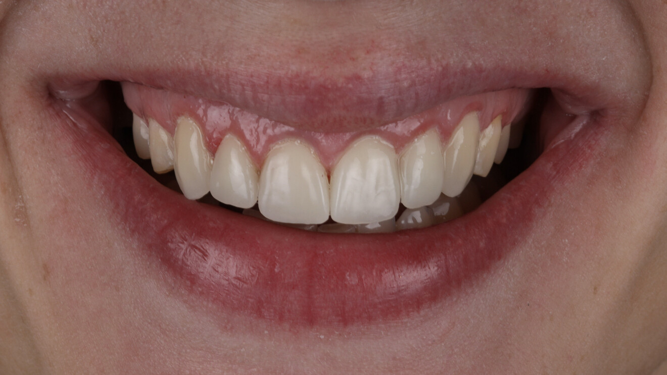 Fig. 7b: Extra-oral close-up smile view showing improved tooth proportions, surface texture and shade integration.