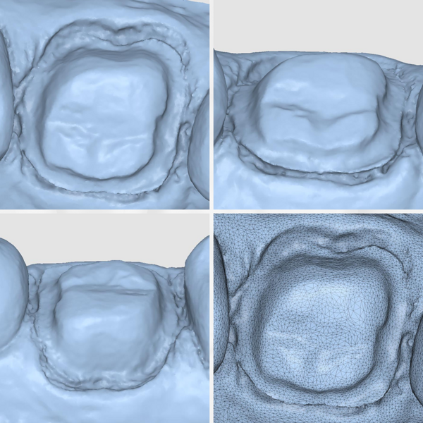 Fig. 9: Preparation margins on the iTero Lumina scan.