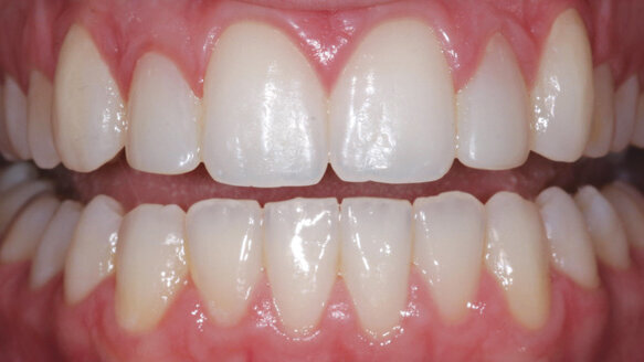 Alternative treatment options with nanohybrid composites