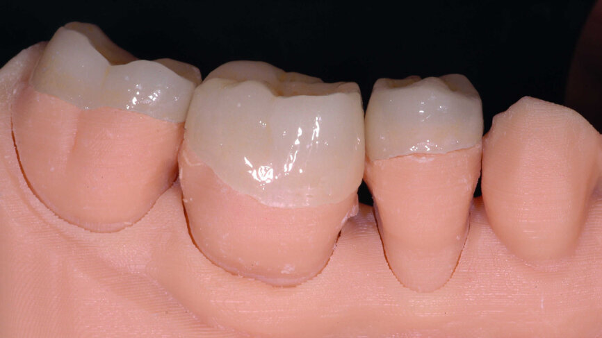 Fig. 7 : Restaurations sur modèle imprimé.