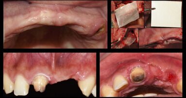Piezocirugía  (11). Casos clínicos de terapia ósea regenerativa con piezoeléctrico