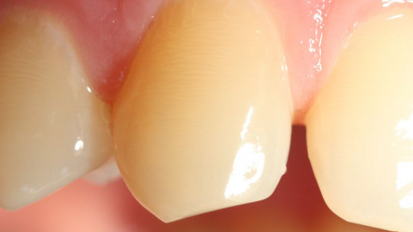 Ранното излагане на ВРА може да повлияе на амелогенезата