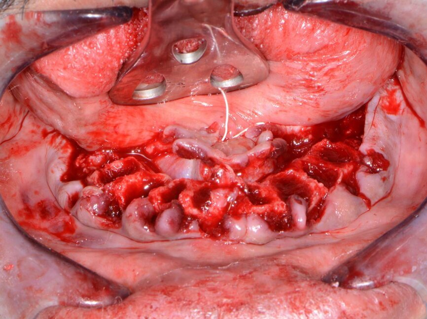 Fig. 12: Remaining ridge after tooth removal.