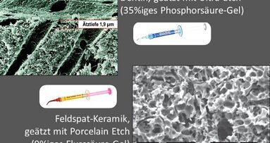 Online-Fortbildung: Zahmediziner gibt Tipps zur Adhäsivtechnik