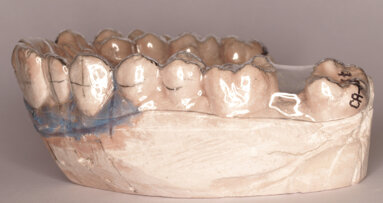 Protocolo del CA® Clear-Aligner en varios pasos a partir de mismo modelo