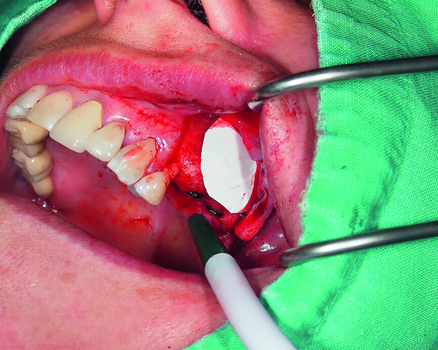 Fig. 9: Covering the access window with an absorbable collagenous membrane.