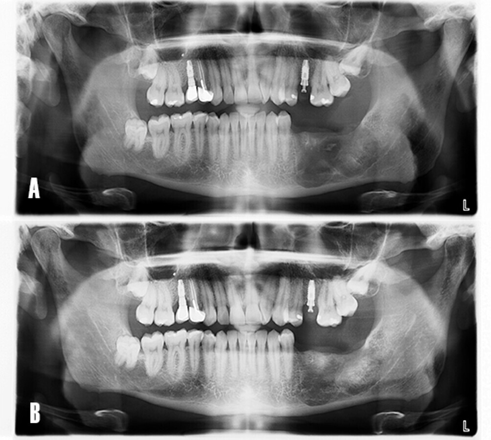 Figura 10. EvoluciÃ³n postoperatoria. El paciente acude a consulta para control radiogrÃ¡fico de la zona intervenida. A) La ortopantomografÃ­a evidencia el Ã¡rea menos radiotransparente y sugiere una neoformaciÃ³n Ã³sea de la cavidad quÃ­stica a los 8 meses. B) A los 12 meses se observa un tejido mÃ¡s radiopaco y con trabeculado Ã³seo, compatible con hueso en fase de maduraciÃ³n.