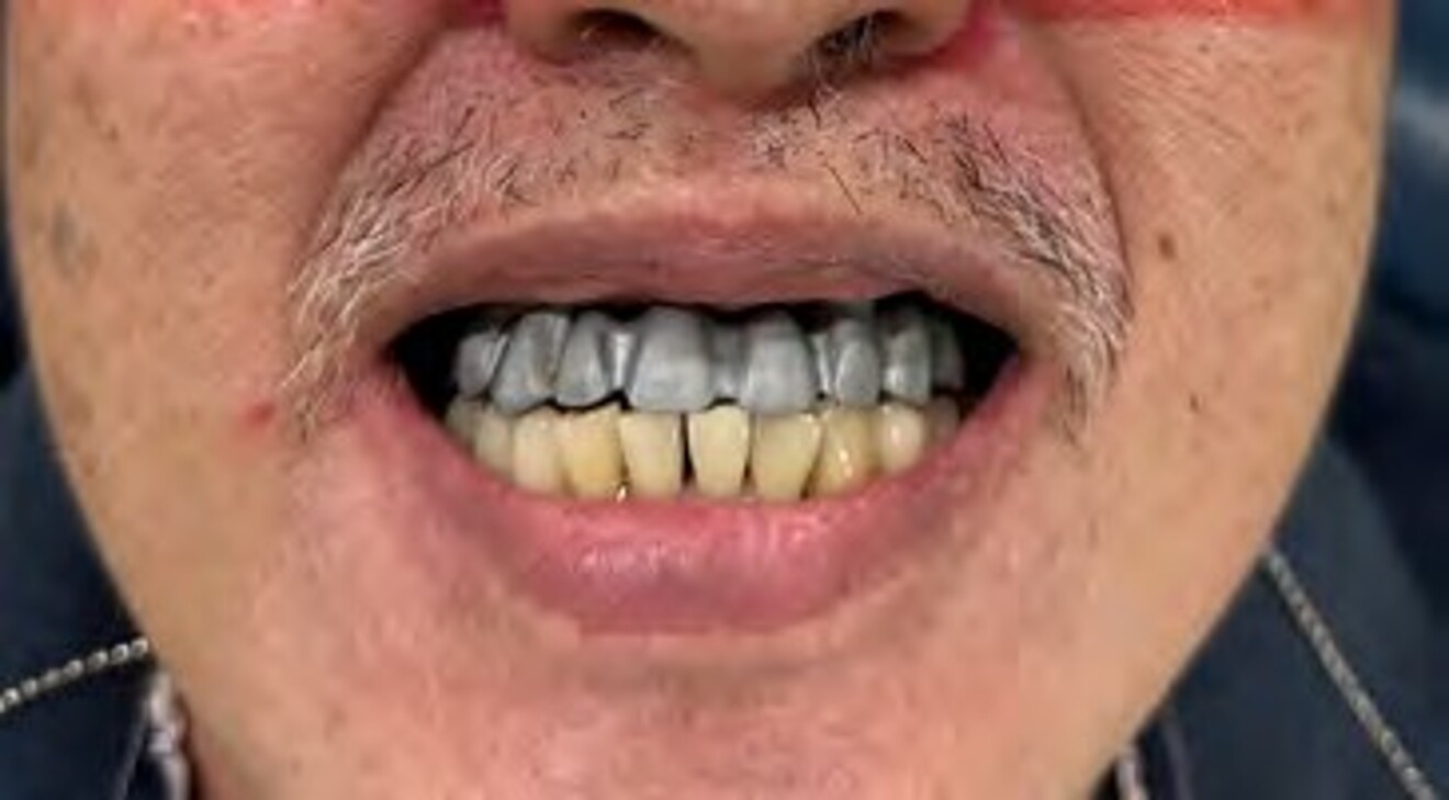 Fig. 2j: Extraoral smile evaluation after mandibular restoration and maxillary framework try-in, confirming the planned occlusal vertical  dimension, overjet, overbite, and smile line before definitive prosthesis delivery.