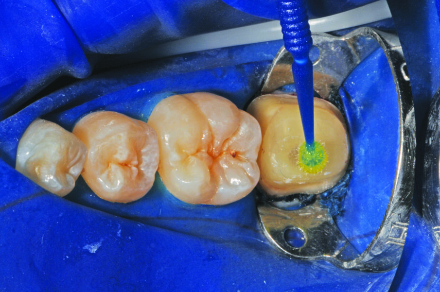 Fig. 7: Apply 3M™ Single Bond Universal Adhesive to the bonding surface rubbing it in for 20 seconds.