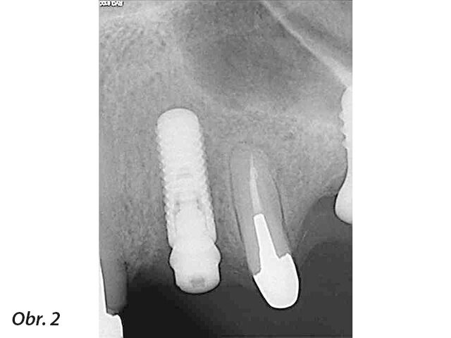 Periapikální léze implantátů a retrográdní periimplantitis