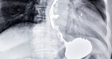 Un test sul respiro per diagnosticare il cancro dell’esofago e dello stomaco