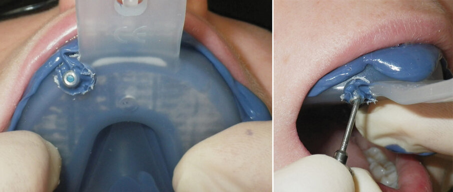 Fig. 12: Once the 3M™ Impregum™ Soft Polyether Impression Material has set, use an implant driver to unscrew the impression screw. Remove the 3M™ Directed Flow Impression Tray.