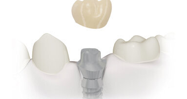 Realizzazione di un abutment implantare customizzato mediante CAD/CAM. Una soluzione specifica per ogni caso clinico
