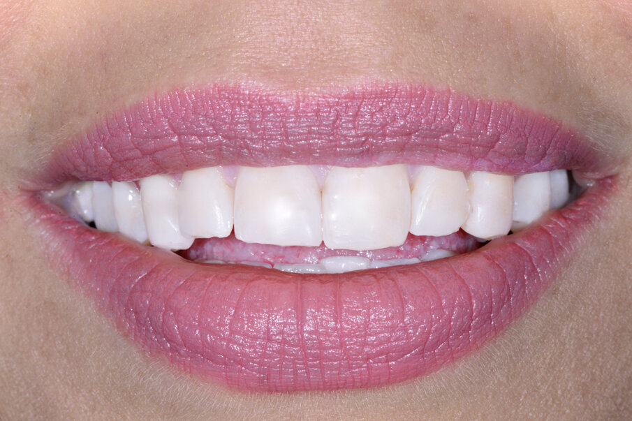 Fig. 4: Older, abraded anterior tooth veneers