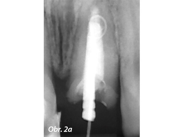 Endodonticky ošetřený zub s píštělí
