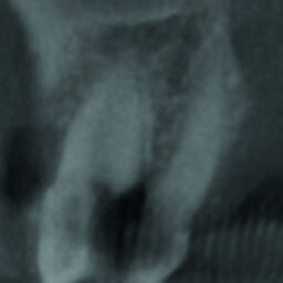 Considérations sur une restauration optimale des dents perforées