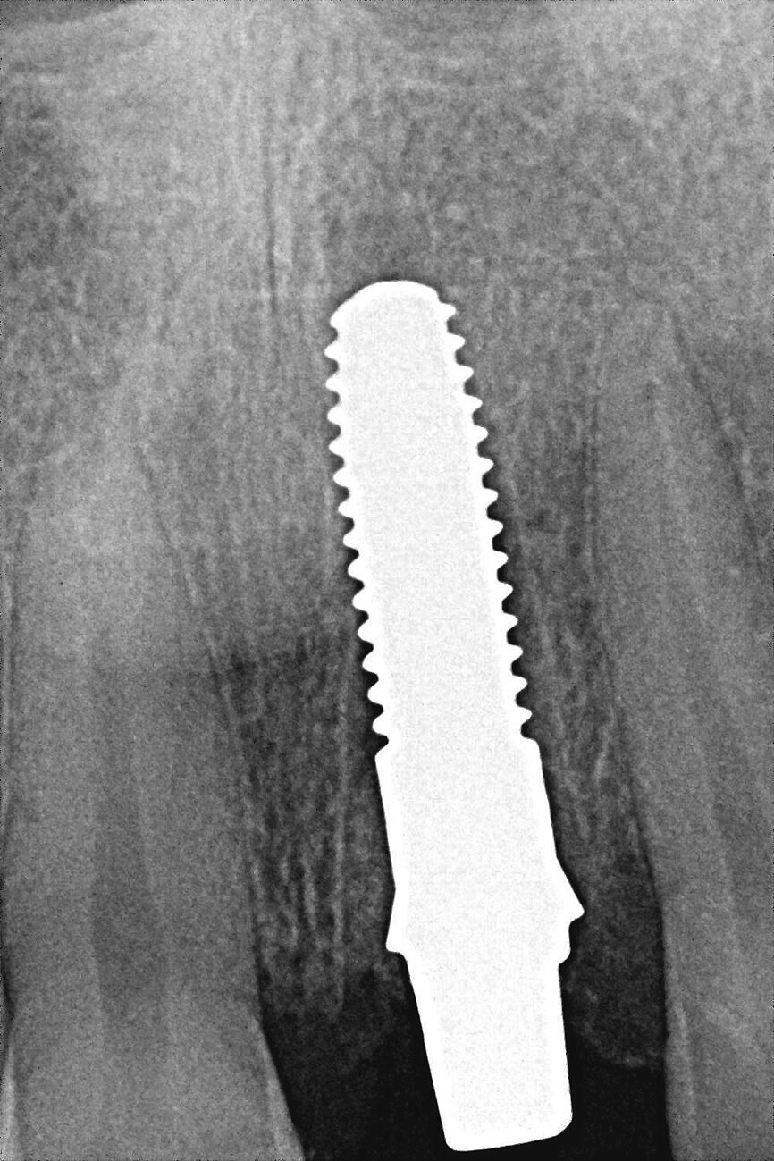 Figs. 3a–c : Implant ZiBone monobloc en zircone (Ø 4,0 mm, longueur 12,0 mm).