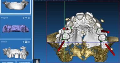 Implantologia guidata con flusso digitale completo in house