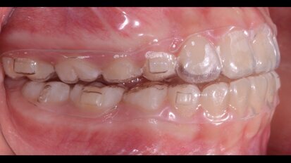 F22 Young, un dispositivo estetico funzionale per il trattamento dei pazienti in crescita con malocclusione di classe II: Case Report