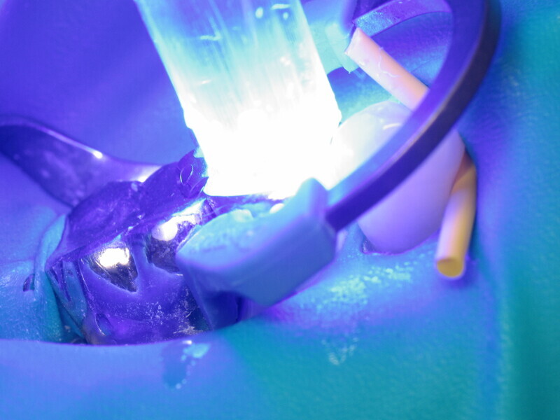 Fig. 16 : Photopolymérisation du composite.