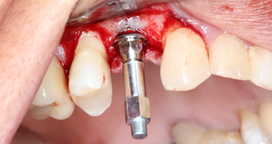 Comparative Study — of implant placement torque and resonance frequency analysis on the implant and abutment
