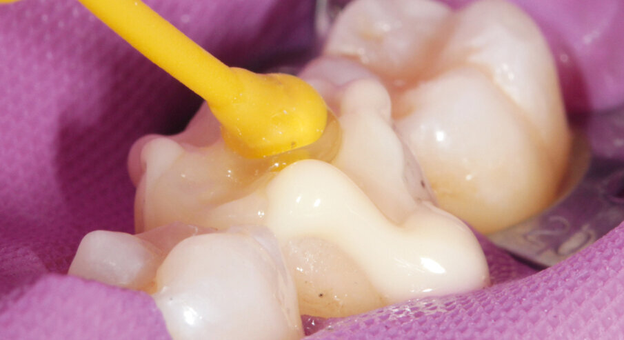 Fig. 12: Inserting and positioning the inlay on the tooth; followed by the removal of excess material