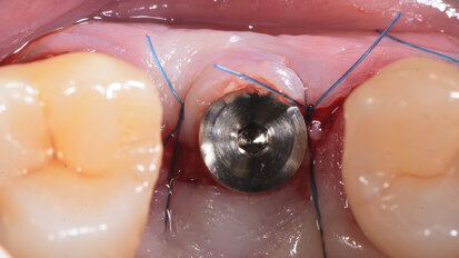 Aspects chirurgicaux d’implants deux pièces en céramique : une solution pour des sites osseux compromis