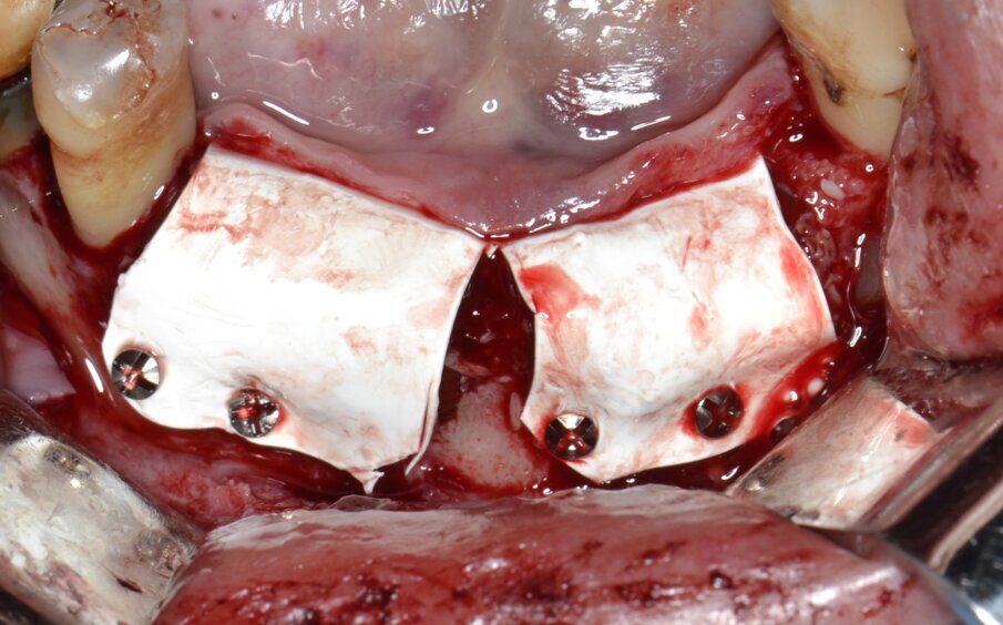 Fig. 10 - La membrana in PTFE viene correttamente allocata e fissata sul versante buccale.