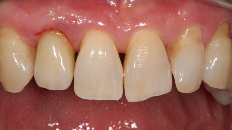 Figg. 6a, 6b - Mucosite perimplantare a carico dell’impianto in sede 12.