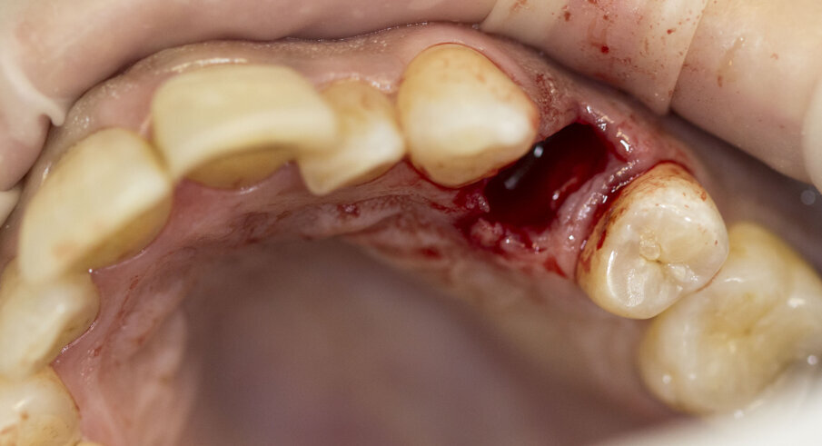 Fig. 4 - Estrazione del dente 2.4.