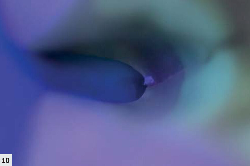 Fig. 10 : D-Light Pro en mode détection permet de confirmer que les limites marginales de la préparation sont toutes positionnées dans l’émail sain. Il ne reste qu’une fissure extrêmement fine, limitée à l’émail. 