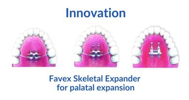 “Favex maxillary expander is patient-centric rather than appliance-centric”: Innovation