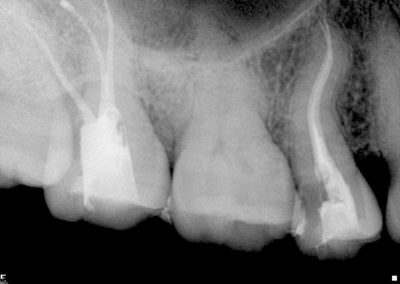 ig. 6: Post-op periapical radiograph, angled view.