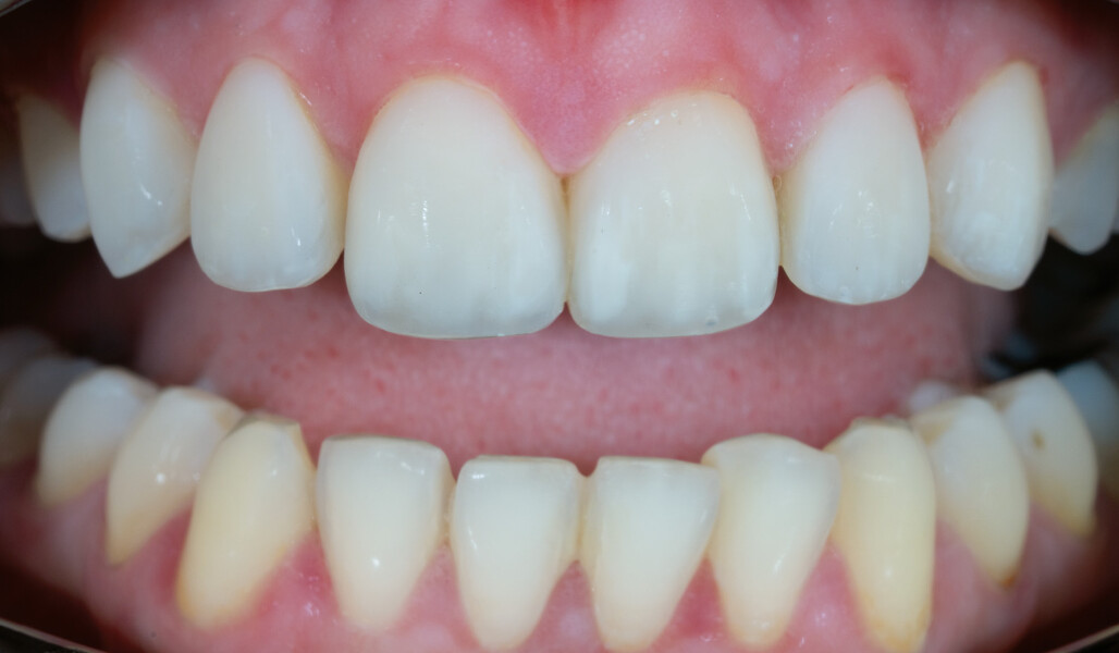 Fig. 9e: Final treatment outcome. Detailed intra-oral view of the internal colour structure, made visible with the aid of a cross-polarising filter.