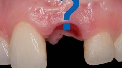 Sposoby zaopatrywania zębodołu poekstrakcyjnego