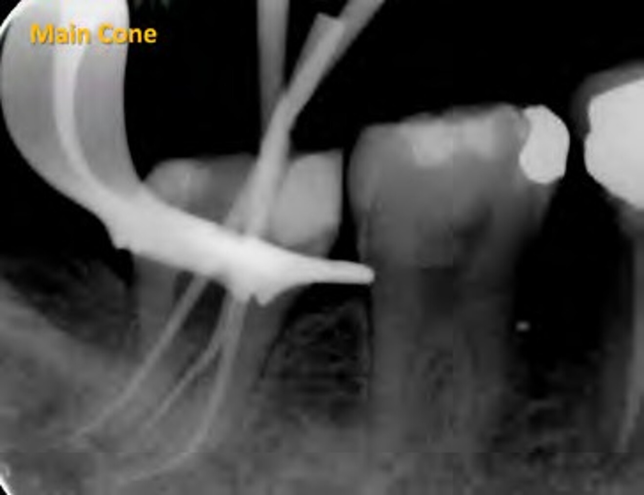  Fig. 1g: Master cone radiograph verifying the adaptation of pre-curved ProTaper NEXT X2 gutta-percha cones prior to obturation. 