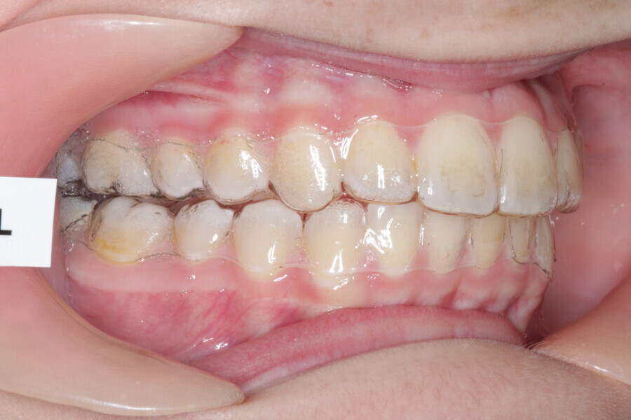 Fig. 18: Aligner #22.