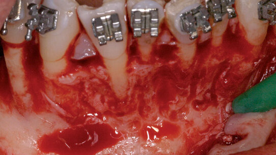 Il movimento ortodontico osteogenico e parodontalmente accelerato nel trattamento multidisciplinare implantare