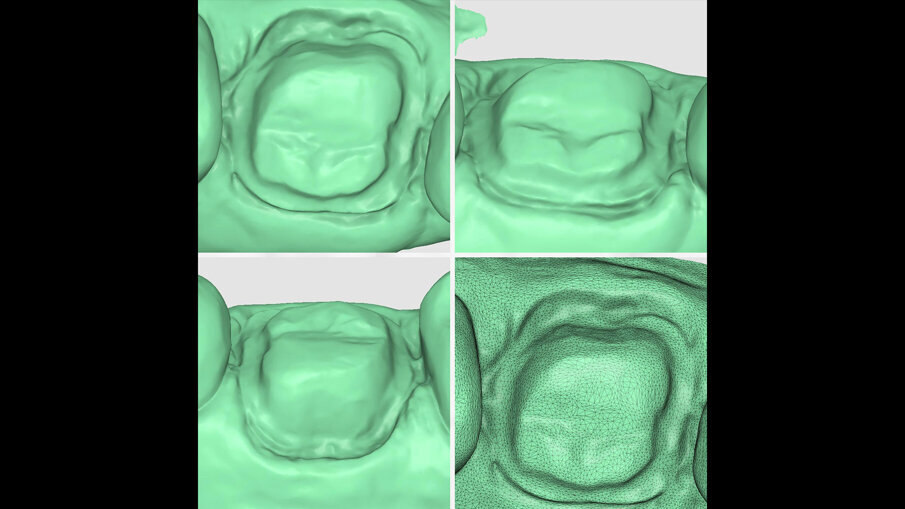 Fig. 7 - Scansione dei margini di preparazione con Aoralscan 3.