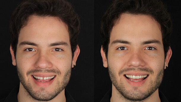 Restauración mínimamente invasiva con carillas de base cerámica