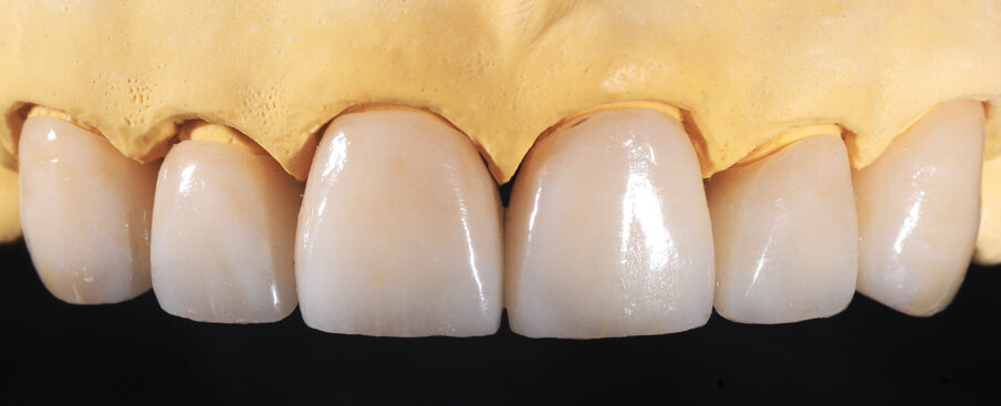 Fig. 12: Completed crowns on the model