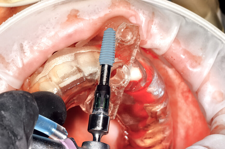 Fig. 23: The implant, seen prior to placement,
using the R2GATE surgical carrier for full-template guidance through the sleeveless guide.