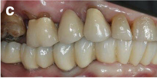 Fig. 14c: Occlusal, frontal and lateral views on the day of delivery, showing healthy peri-implant mucosal conditions (a) and the final CAD/CAM restoration in situ (b–e).