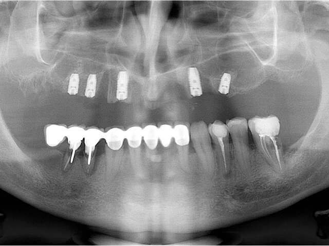 Panoramatický RTG snímek po zavedení implantátů